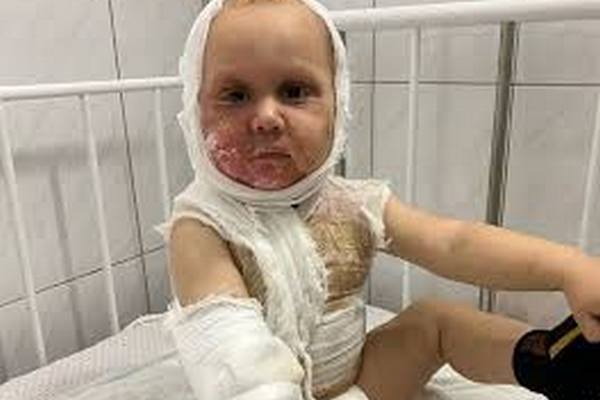 В Запорожье малыш облился чаем - ребенок в больнице