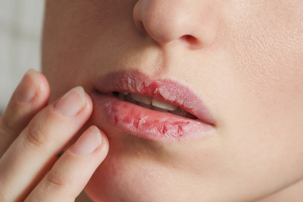 Врач назвала трещинки в уголках губ симптомом опасного заболевания