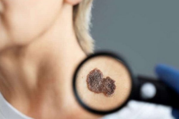 Как обнаружить на теле замаскированный рак кожи — совет эксперта