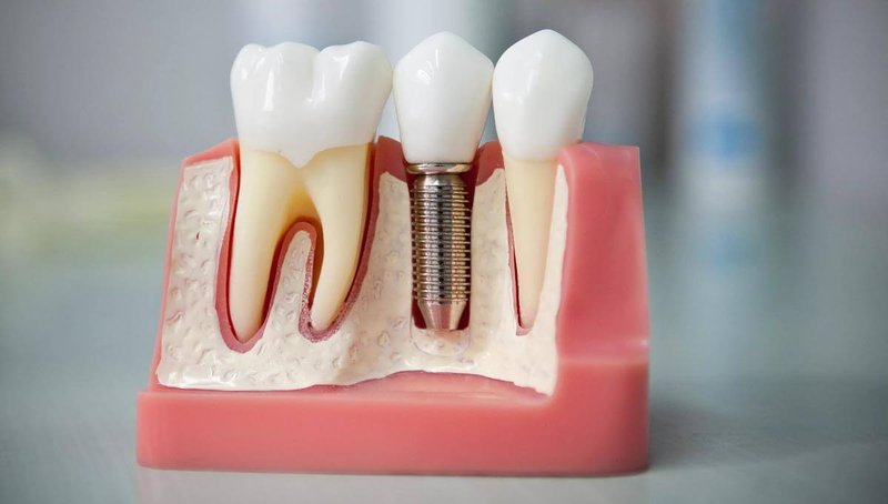 Имплантация зубов после удаления: преимущества и особенности