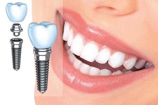 Имплантация зубов после удаления: преимущества и особенности