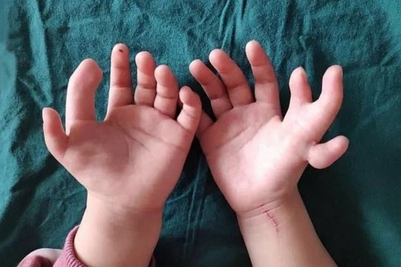 Девочке с 14 пальцами на руках врачи удалили лишние