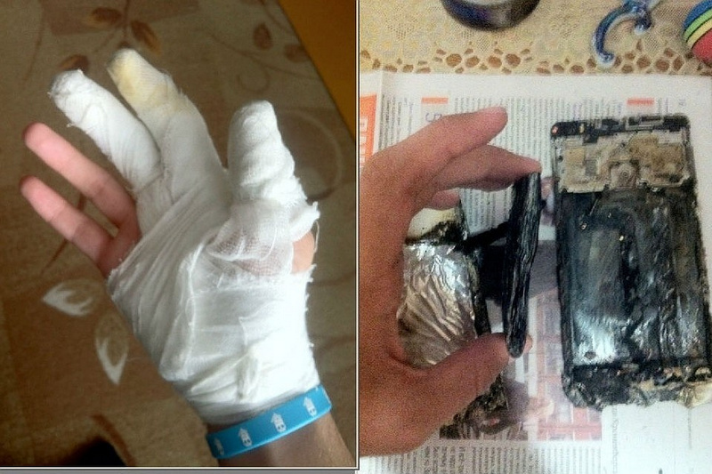 Челябинский школьник пострадал из-за внезапного возгорания смартфона