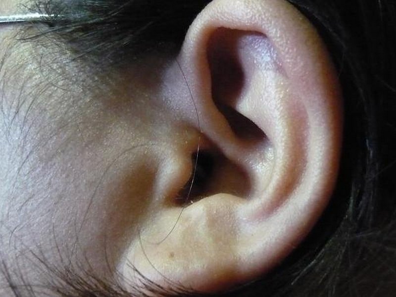 Врачи назвали причину появления шума в ушах